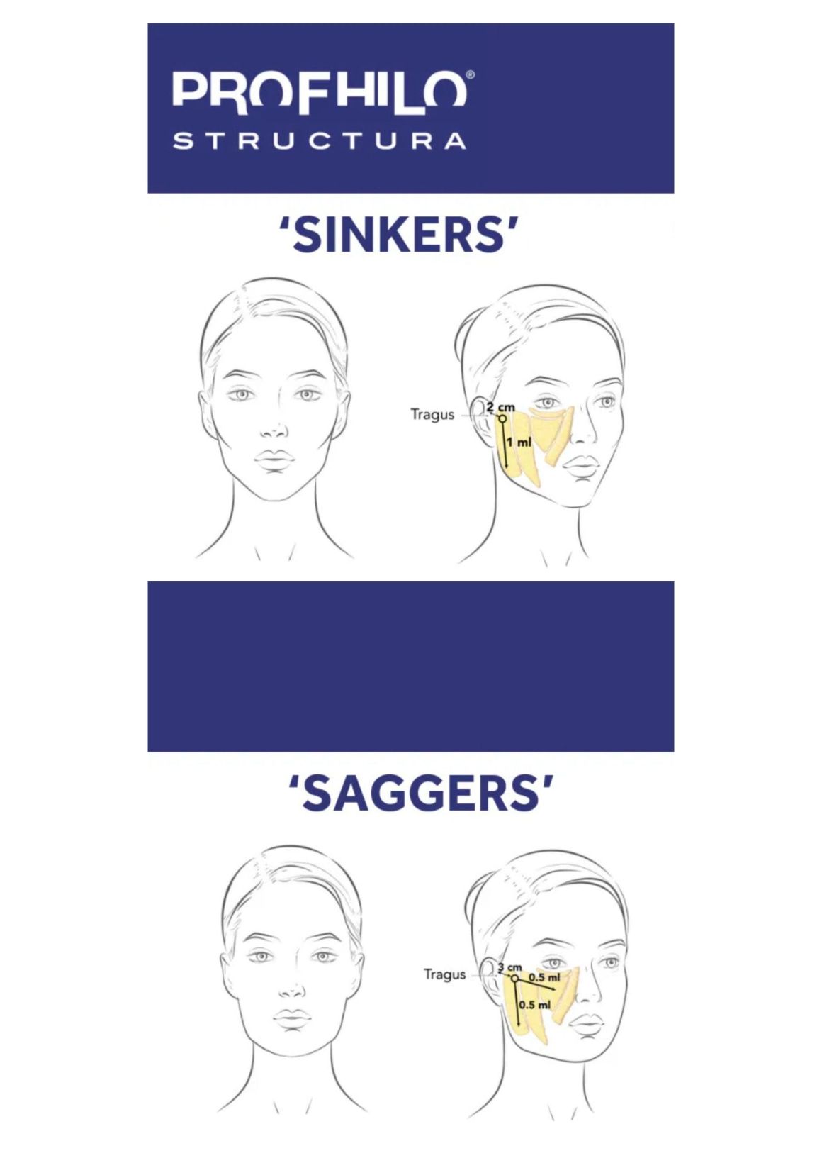نحوه تزریق پروفایلو استراکچرا